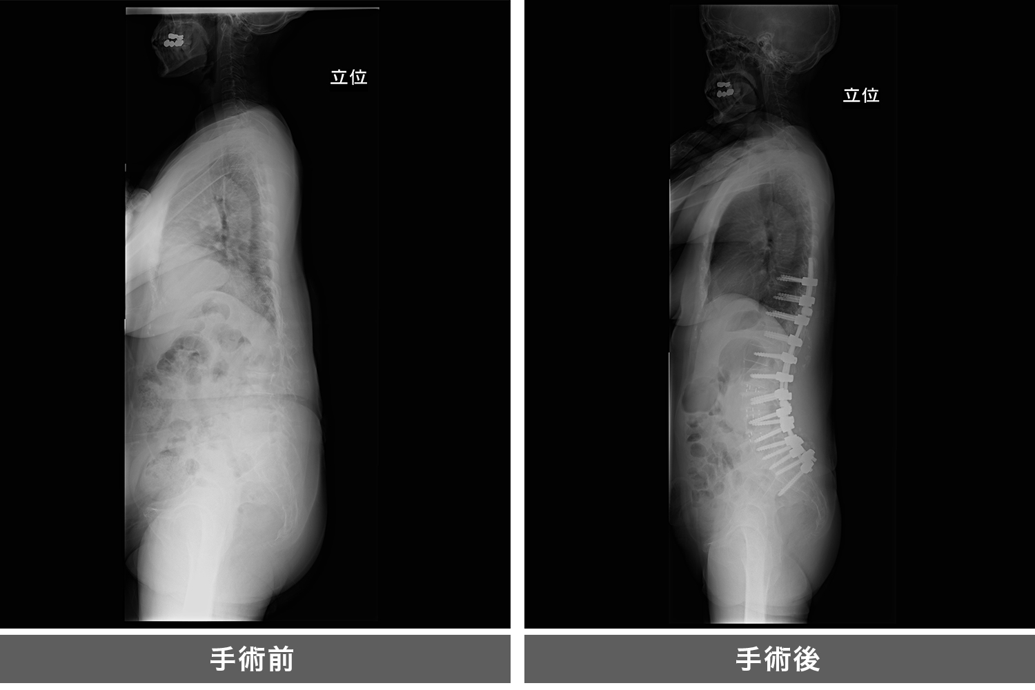 成人脊柱変形、思春期特発性側弯症に対する矯正固定術