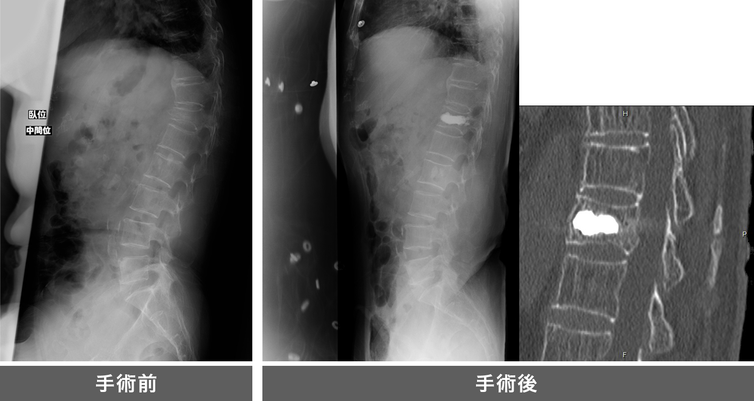 骨粗鬆性椎体圧壊に対する経皮的椎体形成術