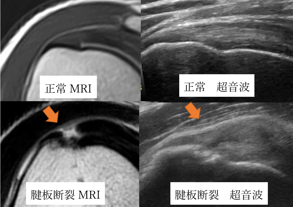図1 腱板断裂の診断（MRIと超音波）	