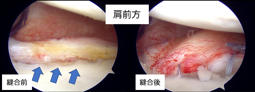 図1 関節鏡による肩関節脱臼手術（前方）