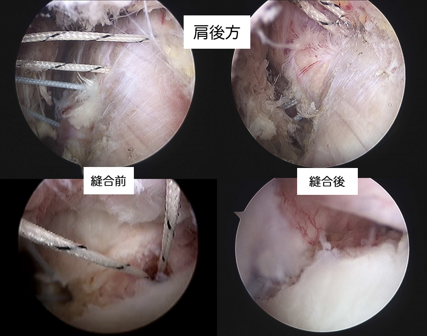 図4 関節鏡による肩関節脱臼手術（後方）