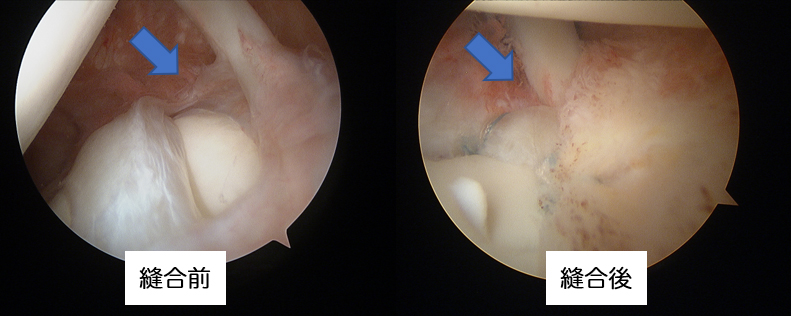 図6 関節鏡によるSLAP修復　（左肩を後方から見る）
