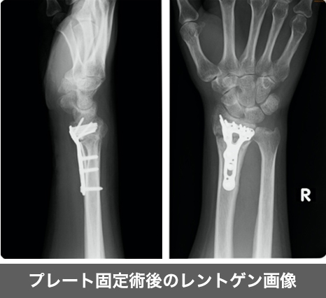 プレート固定術後のレントゲン画像