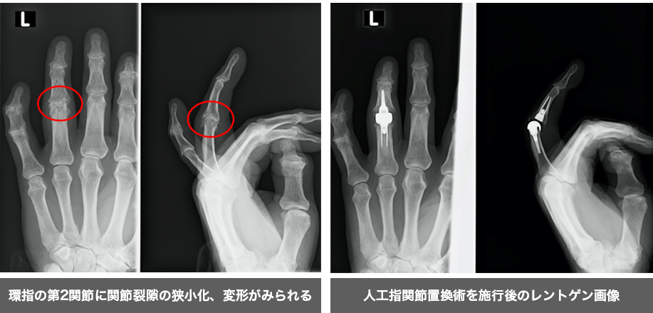 母指CM関節症