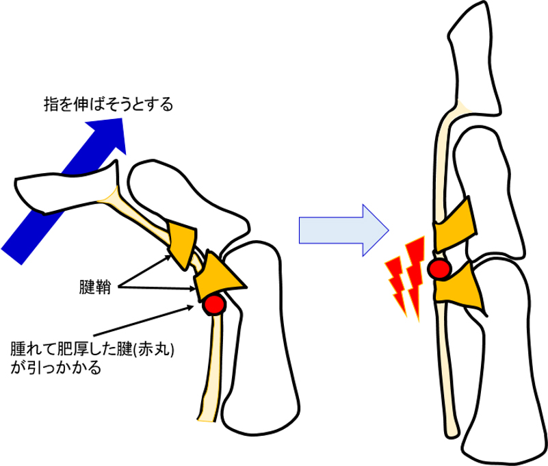 バネ指