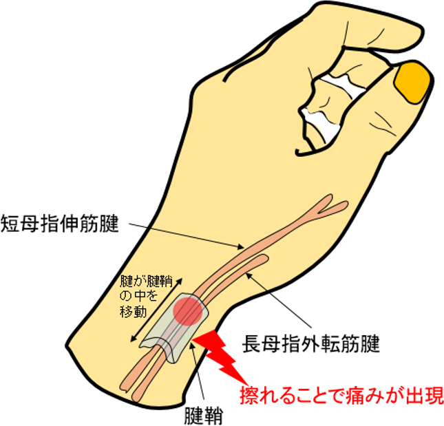 ドケルバン病