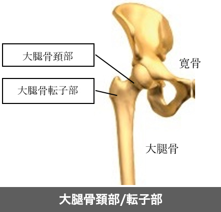 大腿骨近位部骨折
