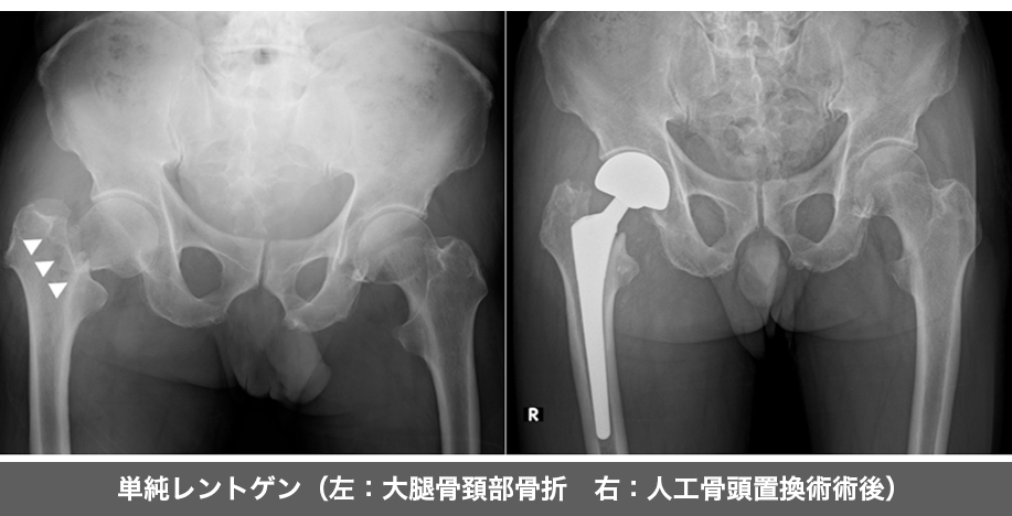 単純レントゲン