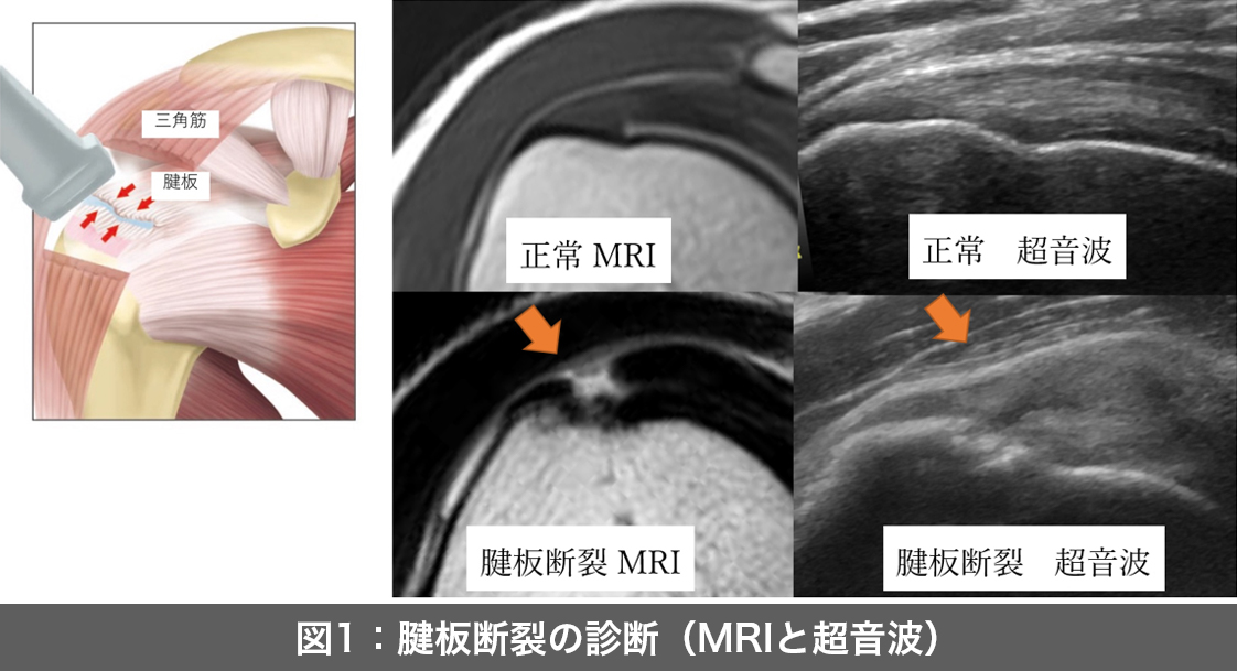 腱板断裂