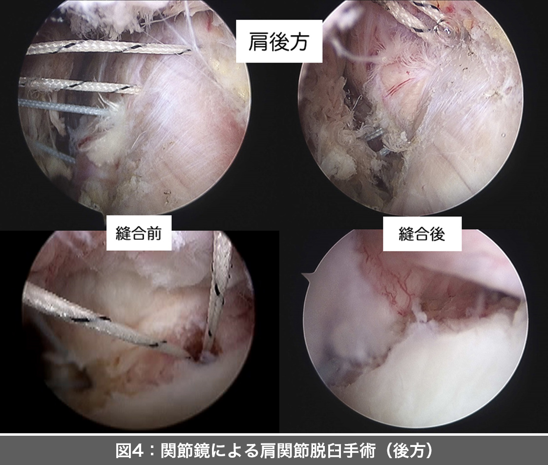 肩関節脱臼