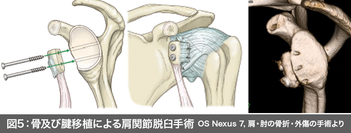 肩関節脱臼