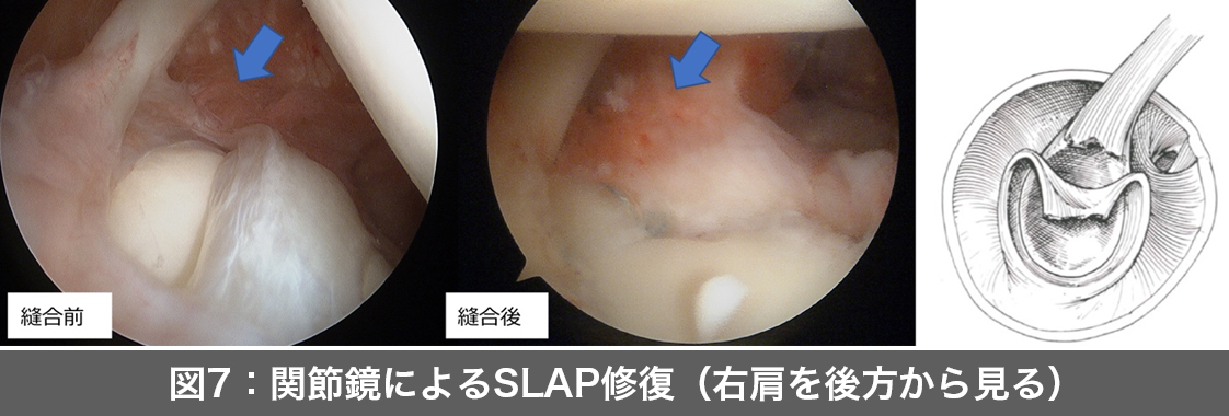 スポーツによる肩関節障害