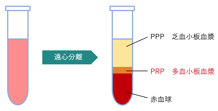 PRP治療とは