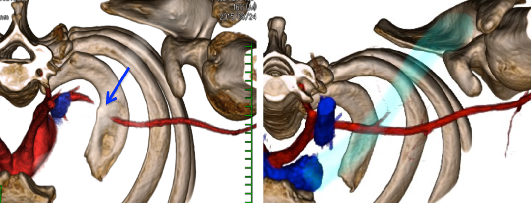 血管造影3D-CT