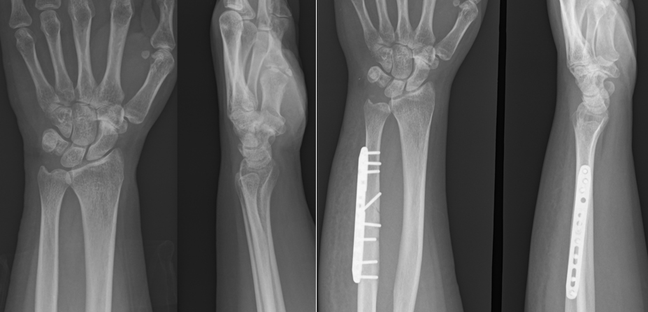 尺骨短縮骨切り術(術前と術後)