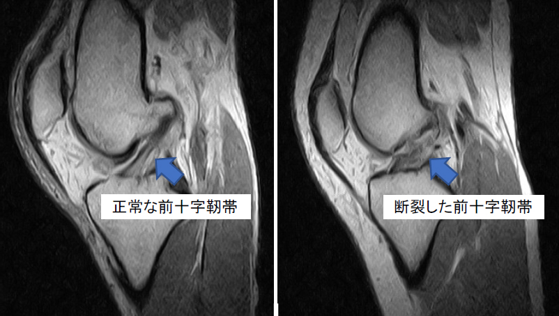 図1 MRIでみえる前十字靭帯