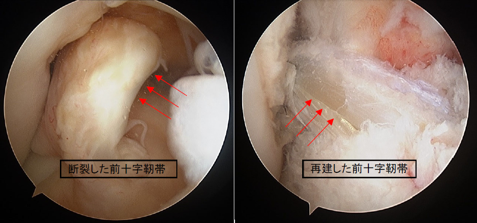 図2 関節鏡でみえる前十字靭帯