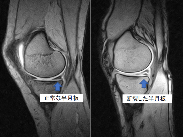 図1 MRIでみた半月板