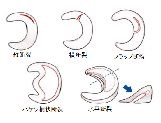 図2 半月板の損傷形態