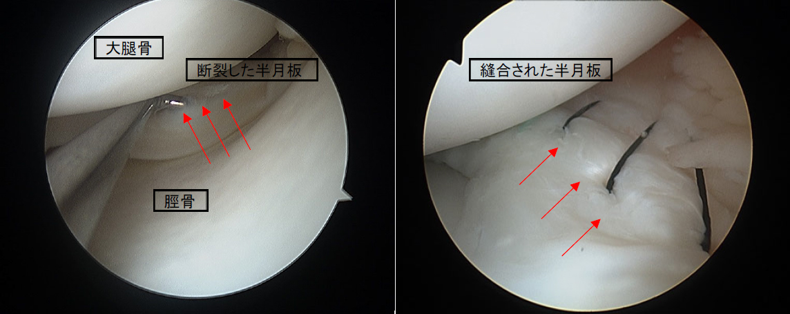 図3 関節鏡でみえる半月板