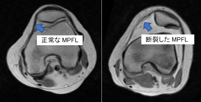 図1 MRIでみた膝蓋骨脱臼