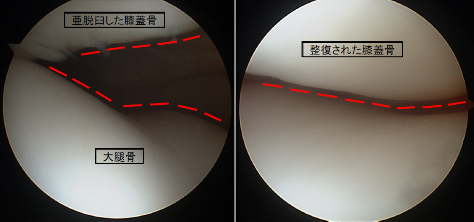 図2 関節鏡でみえる膝蓋骨脱臼