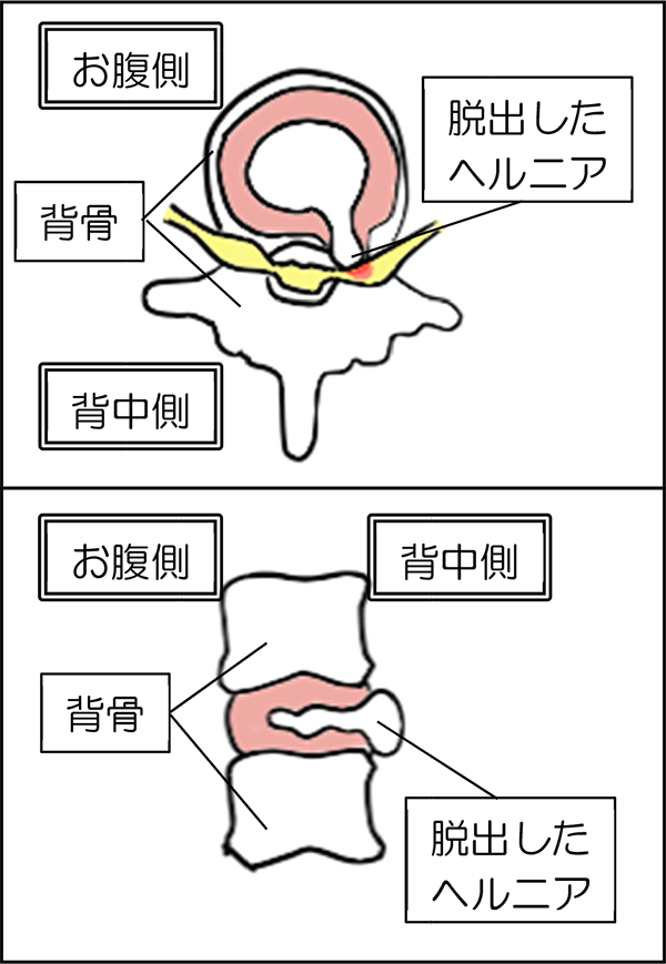 腰椎椎間板ヘルニアの模式図