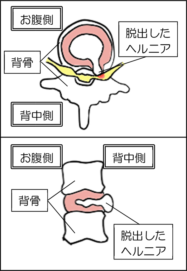 椎間板 ヘルニア 手術