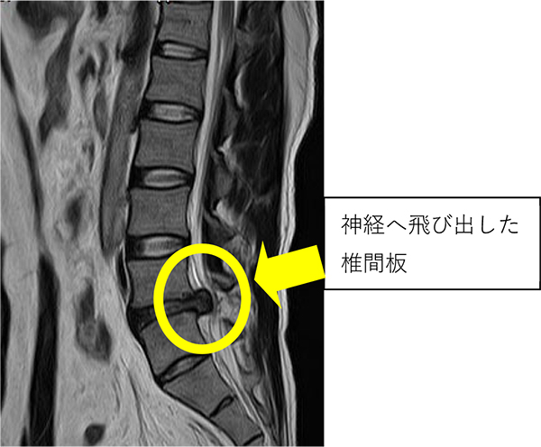 腰椎椎間板ヘルニアのMRI画像