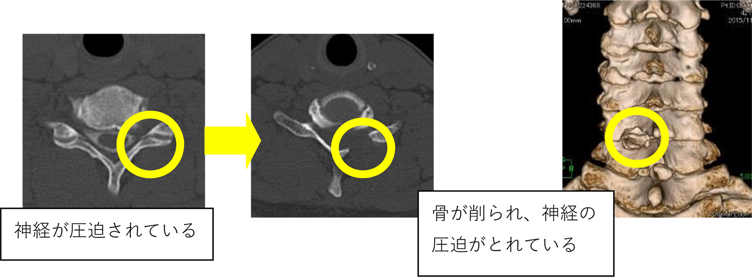 頸椎椎間板ヘルニア