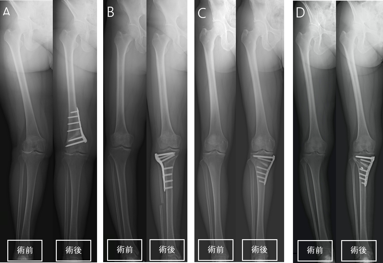 図5 各術式の手術前後のX線（下肢全長）