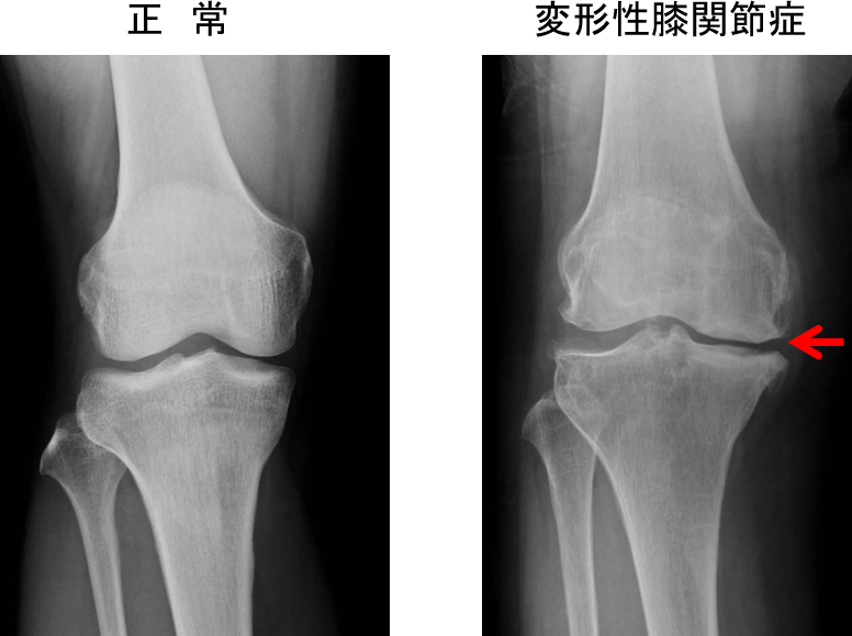 図1. 膝関節単純Ｘ線像