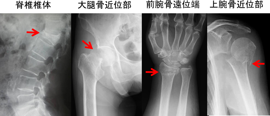 図3.骨粗鬆症の四大骨折