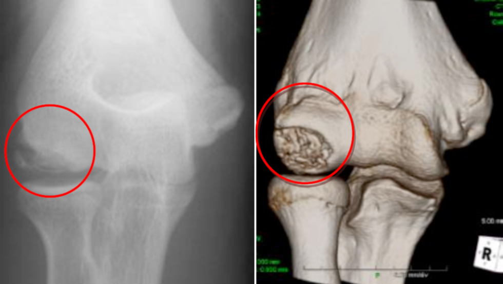 図6 離断性骨軟骨炎　左：レントゲン　右：CT