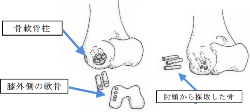 図7 離断性骨軟骨炎手術法(左：骨軟骨柱移植術、右：骨釘移植術)