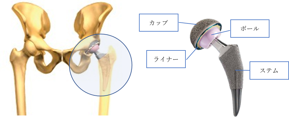 人工股関節のイメージ