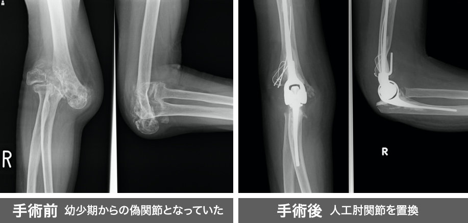 人工肘関節置換術