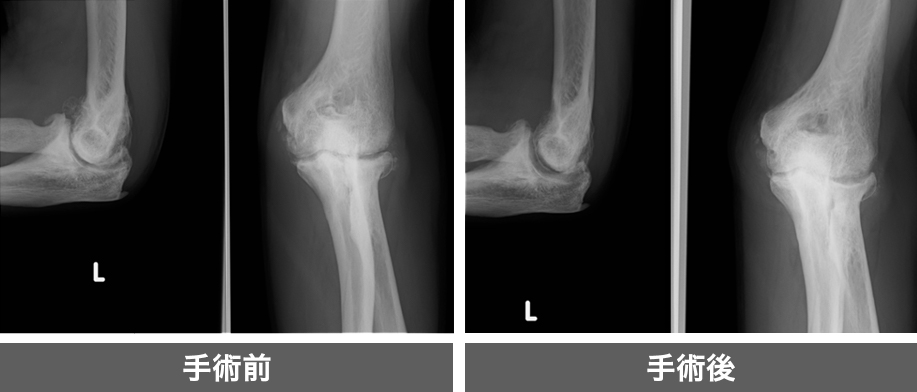 変形性肘関節症（骨棘除去術）